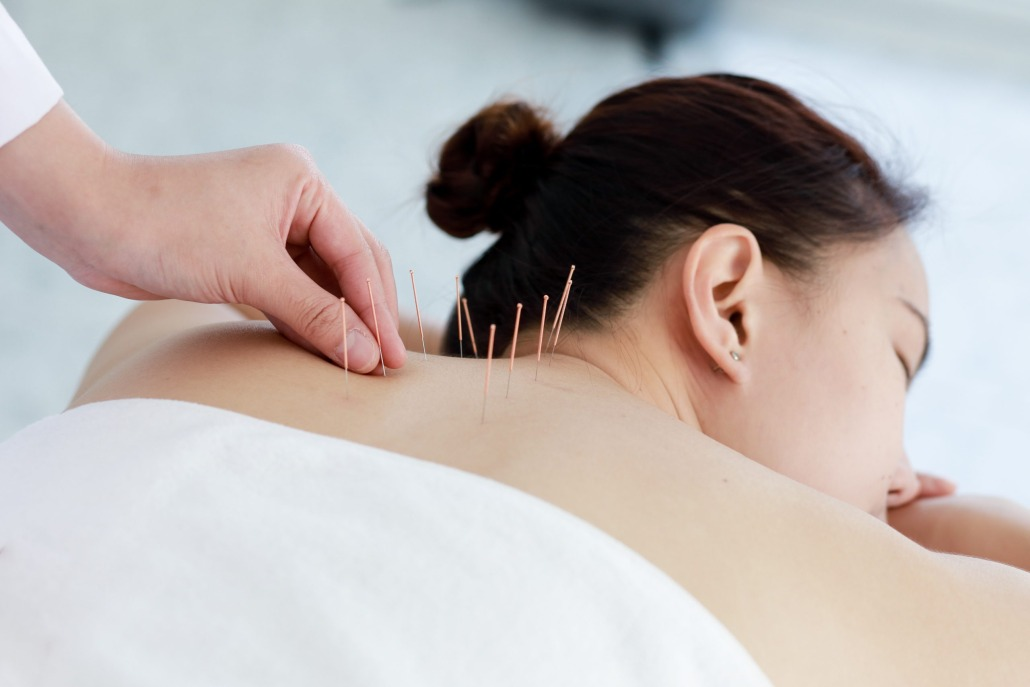 Acupuncture session — fine needles placed along the upper back